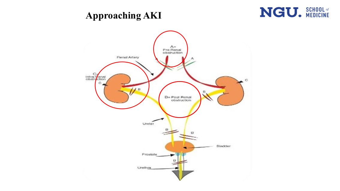 Slide 12 — Approaching AKI, anatomical obstruction sites