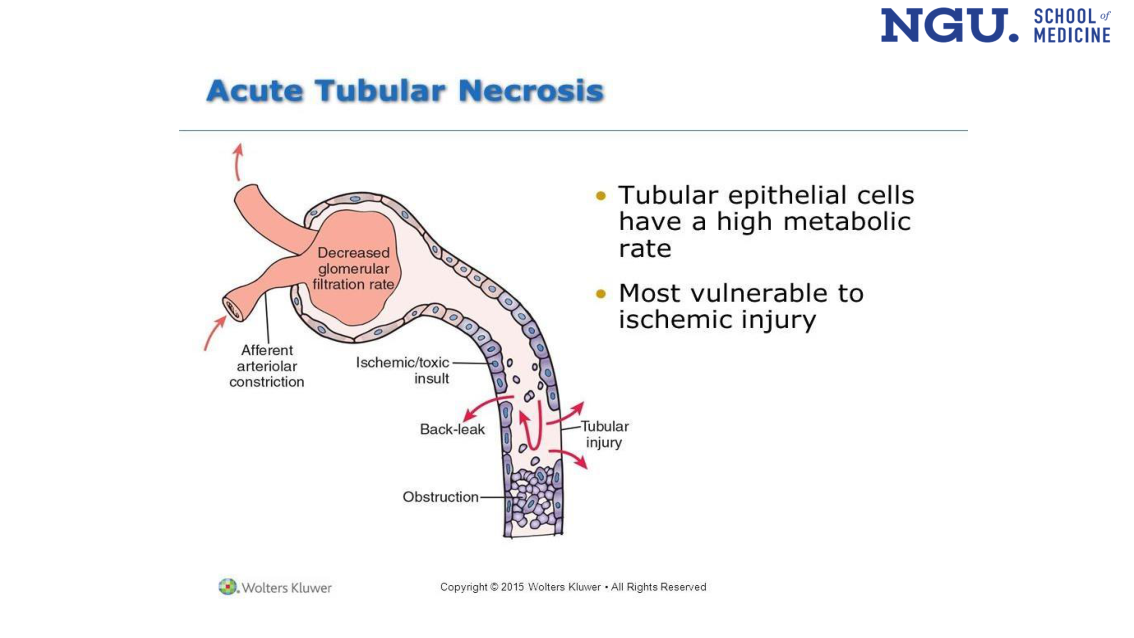 Acute Tubular Necrosis - nephron diagram (slide 23)