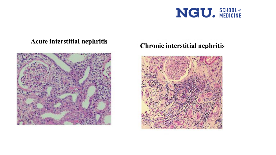 slide27.png — histology, acute vs chronic side by side