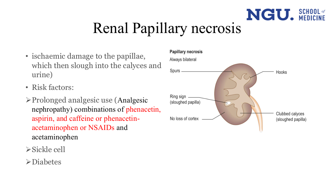 slide32.png — labelled diagram, papillary necrosis
