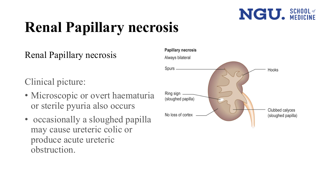 slide33.png — labelled diagram, papillary necrosis (repeat)