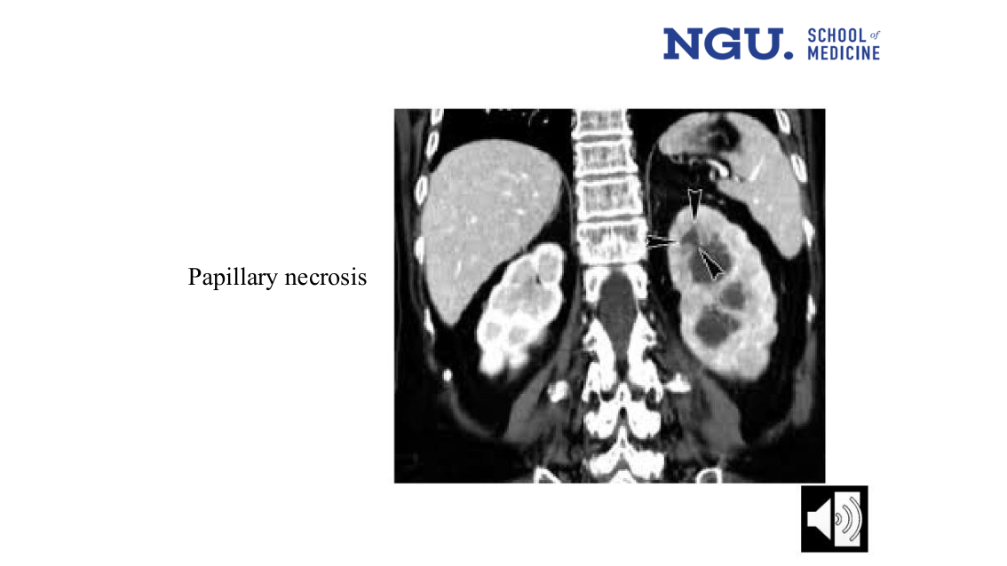 slide34.png — CT, papillary necrosis