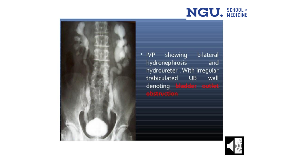 IVP — bilateral hydronephrosis/hydroureter with bladder outlet obstruction (slide 38)