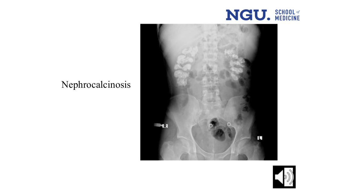 slide41.png (Nephrocalcinosis)